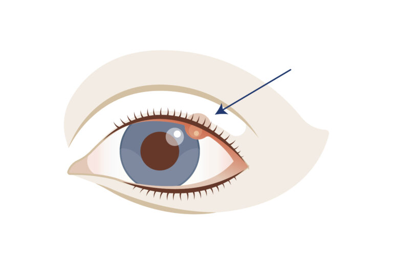 Illustration eines Chalazion (Gerstenkorn) oder Hordeolum (Hagelkorn)