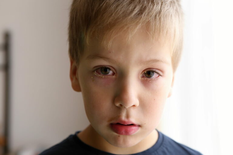 Kindergartenkind mit Konjunktivitis an beiden Augen