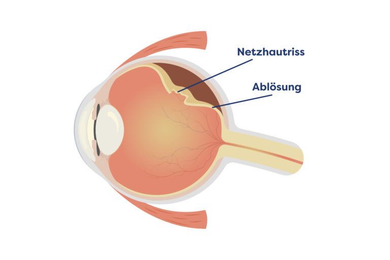 Illustration eines Netzhautrisses, der zur Ablösung der Netzhaut (Netzhautablösung) führt