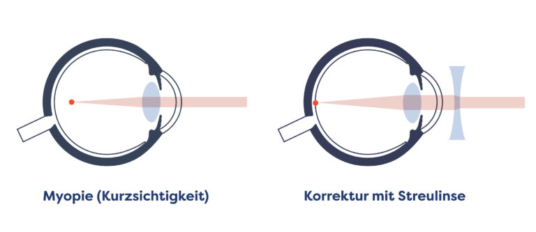 Schema Myopie und Myope Korrektur