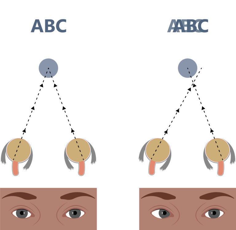 Illustration zeigt, wie Doppelbilder entstehen, wenn beide Augen nicht auf den selben Punkt schauen.