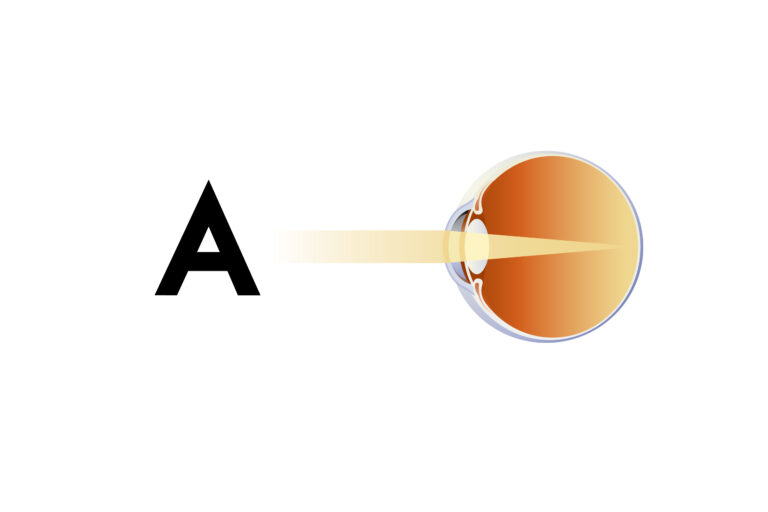 Illustration des Strahlenganges (Optik) bei einem normalsichtigen (Emmetropen) Auge